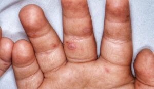 Read more about the article ଅନୁଗୁଳରେ ୭ ସନ୍ଦିଗ୍ଧ  ଏଚ୍‌ଏଫ୍‌ଏମ୍  ରୋଗୀ