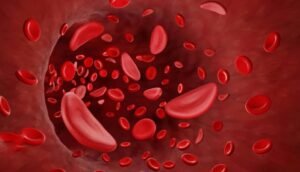 Read more about the article ବିଶ୍ଵ ରକ୍ତ ଶିକୁଳି ସଚେତନତା ଦିବସ